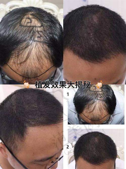 呼和浩特瑞丽诗植发医院项目特色