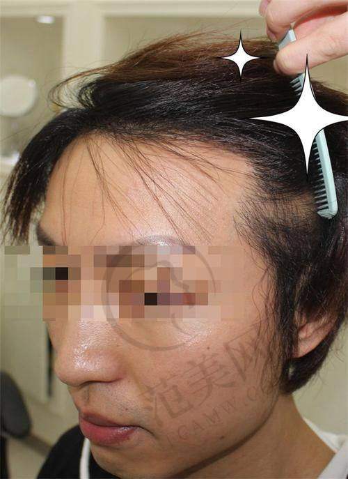 北京科发源植发医院口碑好不好？附真实患者口碑评价