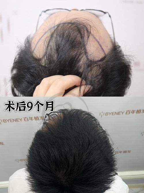 赵进医生植发手术的技术优势