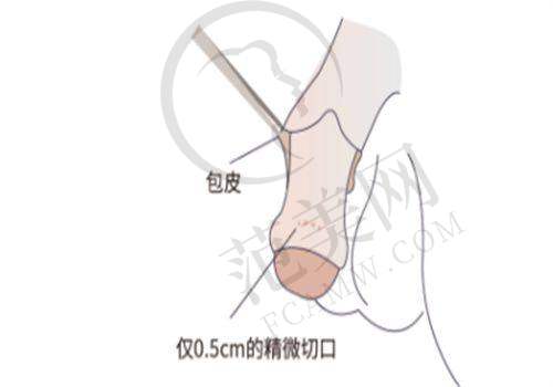柳州华美整形皮秒激光picosure蜂巢皮秒全模式1257元起项目简介