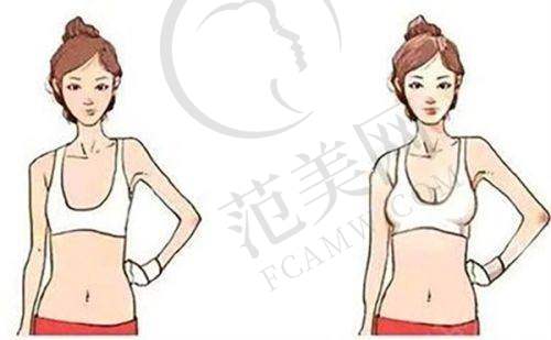 绍兴华美乳头缩小术改善8523元起怎么样预约