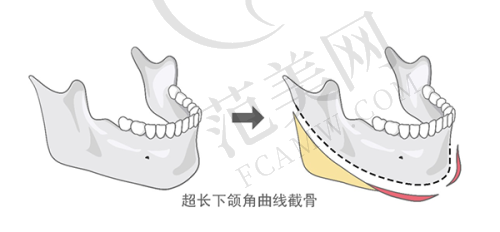 绍兴华美乳头缩小术改善8523元起划算吗