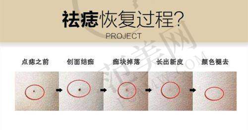 上海星彩玻尿酸淡化黑眼圈1185元起顾客实例参考