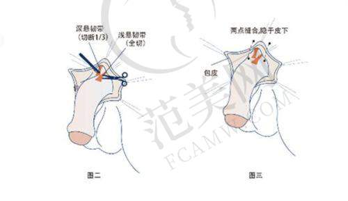 厦门美菜上下唇厚唇改薄3890元起划算吗