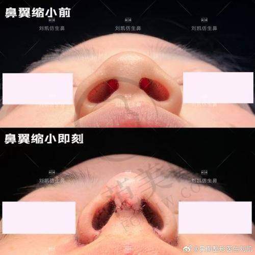 南宁健丽鼻头缩小术5080元起预约方式
