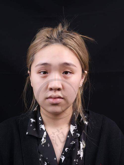 吴开泉医生鼻整形手术的技术优势