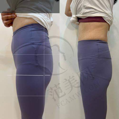 绍兴华美负压腰腹吸脂7797元起顾客实例