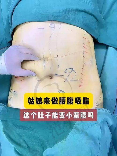 绍兴华美负压腰腹吸脂7797元起项目总结与建议