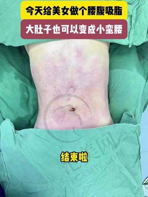 绍兴华美负压腰腹吸脂7797元起如何预约