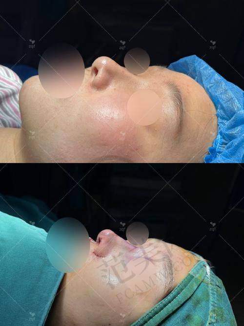 南宁健丽鼻头缩小术5080元起项目详情