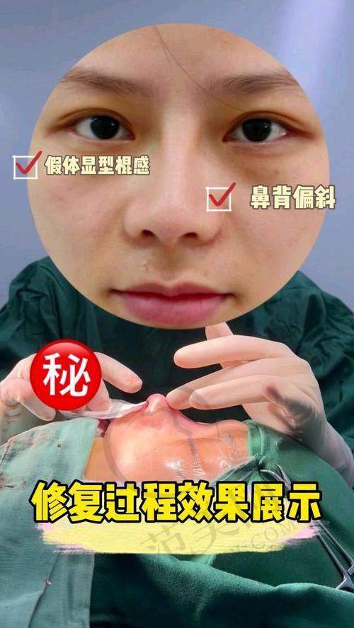 南宁健丽鼻头缩小术5080元起医生团队