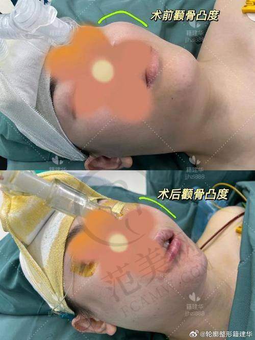 南宁健丽鼻头缩小术5080元起顾客实例展示