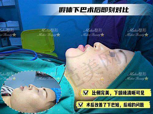 南宁健丽鼻头缩小术5080元起优势解析