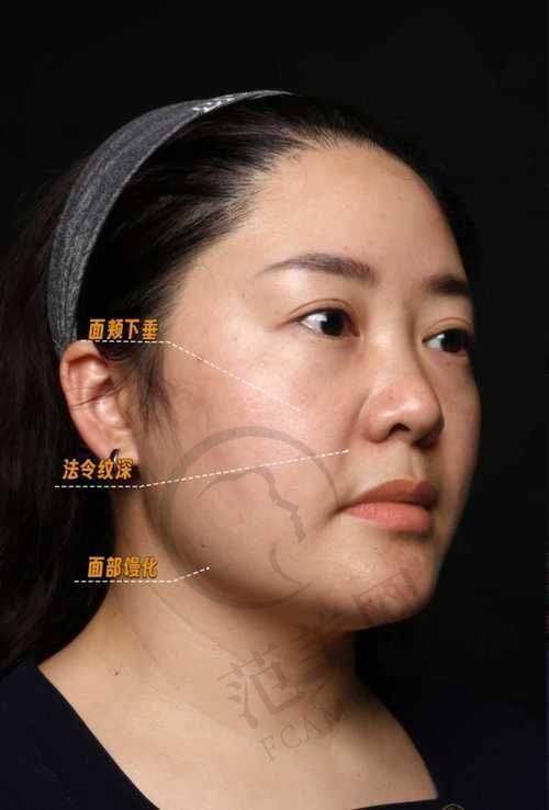 宜昌华美冭活泡泡水光393元起顾客实例展示