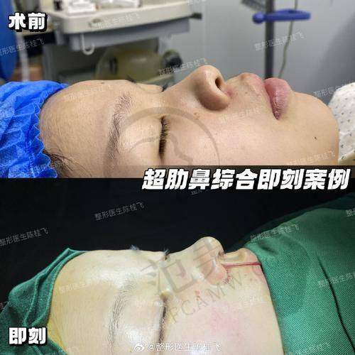 保定芳华丽格韩士生科鼻假体7087元起项目简介