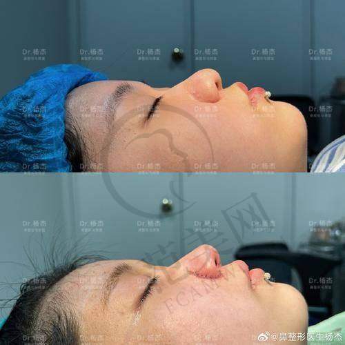 保定芳华丽格韩士生科鼻假体7087元起顾客实例