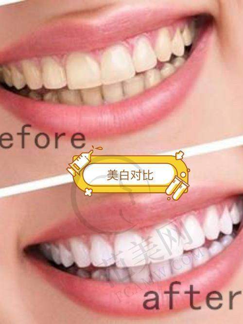 苏州工业园区旭海英博口腔门诊抖音团购活动有哪些，价格表