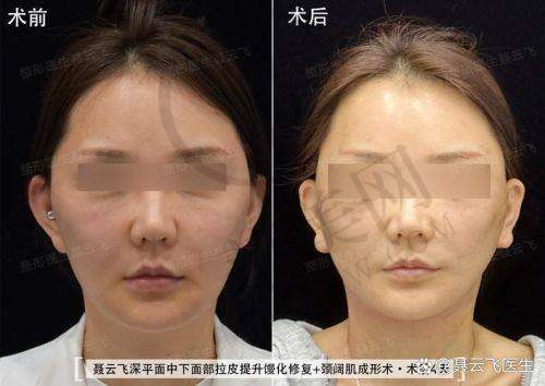 成都刘远程医生口碑怎么样？手术成效显著