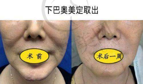 二、广州荔湾清奥中 心取异物是否出名？口碑实力双认证