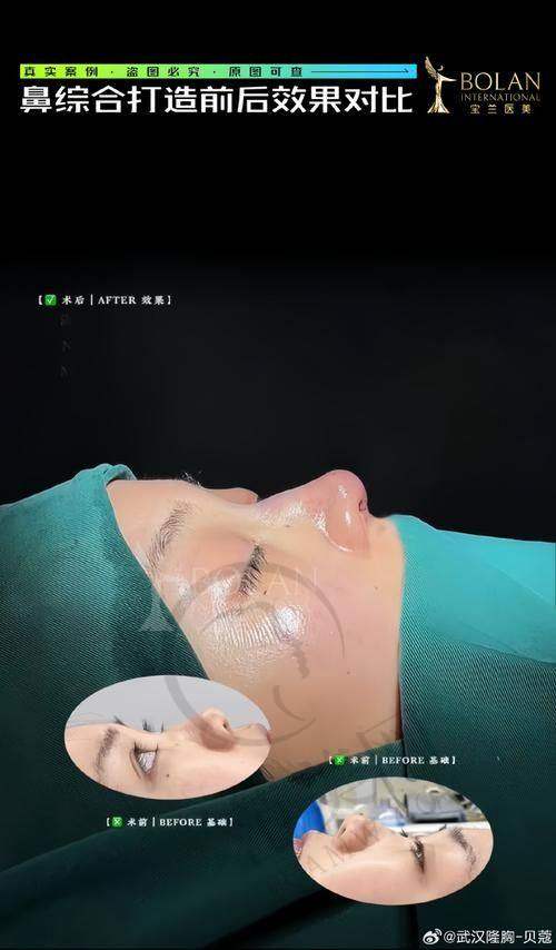 武汉同济整鼻子价格表：其他注意事项