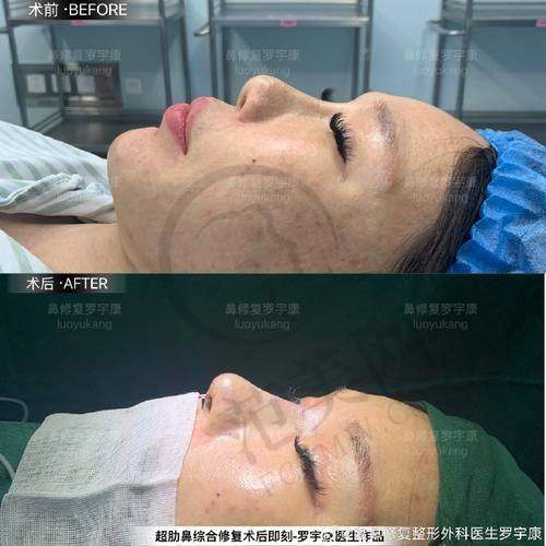 武汉同济鼻综合多少钱？不同材料隆鼻价格