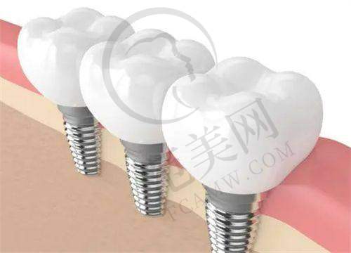 香港种植牙价格之不同医院收费标准差异