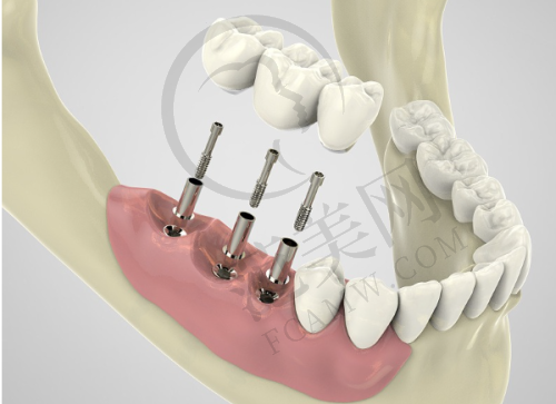 广州广大口腔肖盼盼手术价格详情