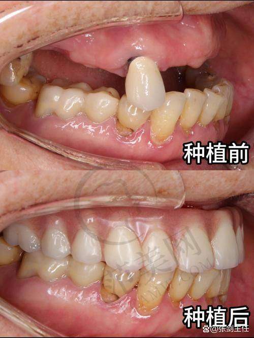 东莞即刻种植牙2025价格表全解析,单颗4000元起半口5万起多机构可选