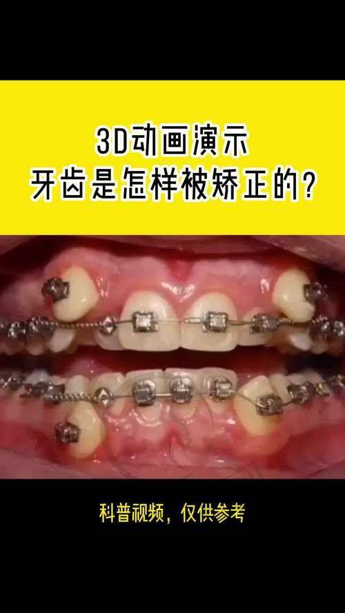 广州骨性龅牙医院价格对比之价格构成