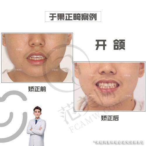 广州骨性龅牙医院价格对比详情