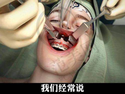 广州骨性龅牙医院价格对比:3200元金属托槽与5 - 10万正颌手术怎么选?