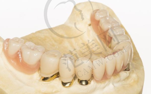 重庆贵金属烤瓷牙费用多少钱——重庆牙博士诚嘉口腔医院