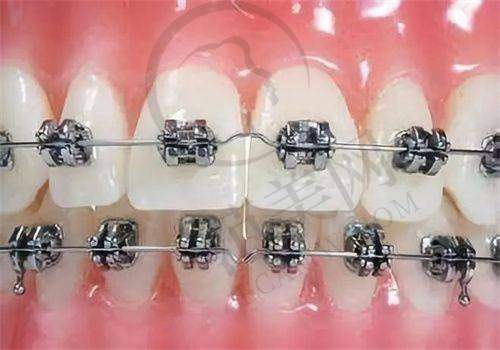 重庆贵金属烤瓷牙费用多少钱——重庆大学医院口腔科