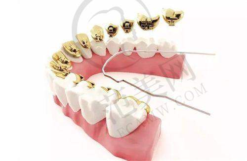 重庆咬合矫正贵吗——重庆市第五人民医院口腔科