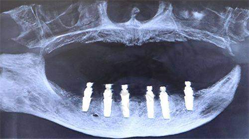 重庆贵金属烤瓷牙费用多少钱——重庆爱牙世家口腔