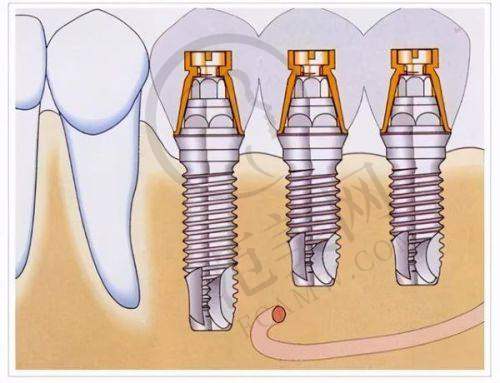 重庆韩国登腾Dentium2025价格表之半口/全口修复方案费用