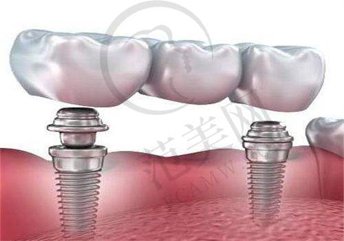 重庆附近哪家做瑞士士卓曼Straumann医院好——重庆牙博士口腔（合川院区）