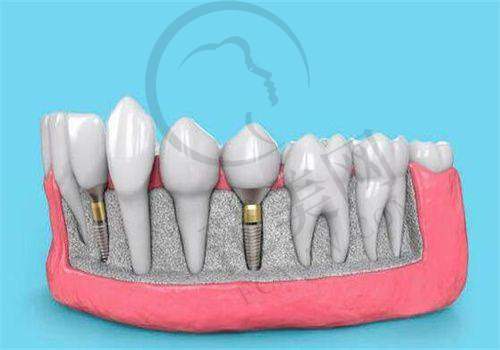 重庆上颌前突哪个好:重医附口腔杜跃华宋锦璘等专家擅长矫正