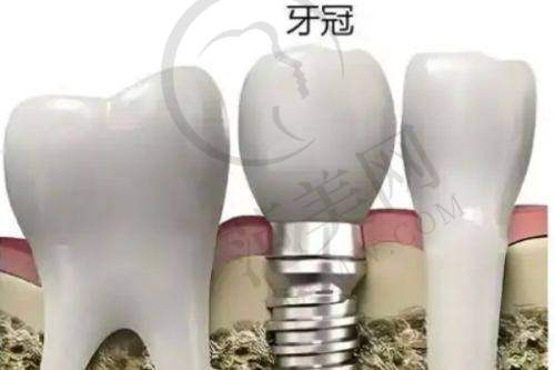 重庆德国AKLAS种植牙医院医生项目介绍