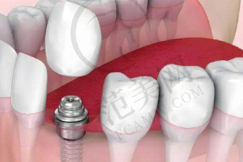重庆韩国登腾Dentium2025价格表之综合分析与建议