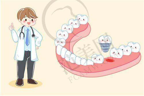 重庆西班牙MG种植牙——重庆渝北邹敏美尔康口腔门诊部