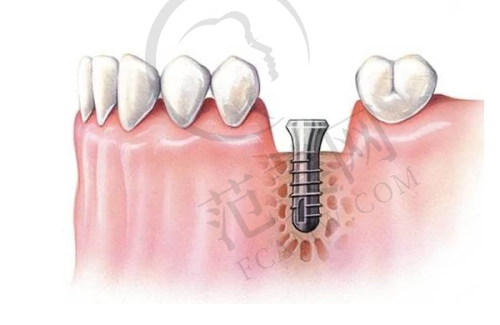 重庆附近哪家做瑞士士卓曼Straumann医院好——重庆合川摩尔口腔医院