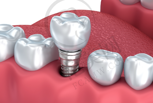无锡德国费亚丹Frialit种植体价格影响因素