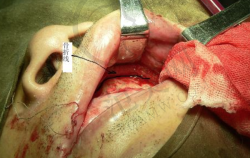 重庆附近哪家做瑞士士卓曼Straumann医院好——重庆团圆口腔医院