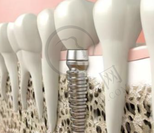 重庆德国AKLAS种植牙不同医院价格策略