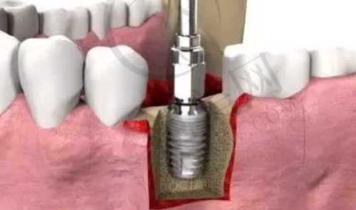 重庆市第五人民医院口腔科——高性价比韩国美格真种植牙