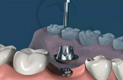 重庆西班牙MG种植牙——重庆成佳牙博士口腔医院