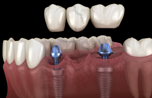 重庆德国AKLAS种植牙医院选择总结
