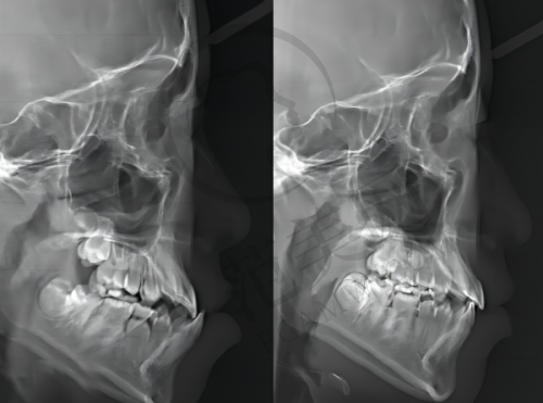 无锡下颌骨矫正医院价格对比,含25805元下颌缩骨及15398元下巴截骨费用解析