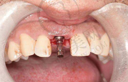 2025年重庆义齿医院排名——重庆维乐口腔